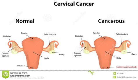 Still, any delay in seeking medical help may allow the disease to progress even further. Cervical Cancer stock vector. Illustration of physiology ...