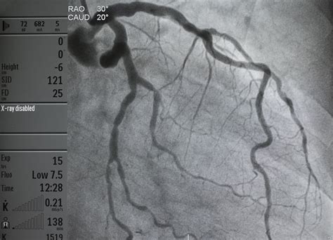 Markers To Predict Ci Aki In Patients With Acs Undergoing Coronary