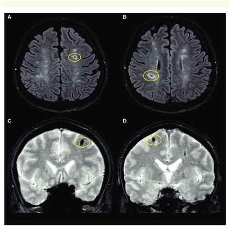 Multiple Microbleeds In Cerebral Infraction Detected On Magnetic