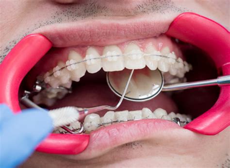Ceramic Braces London Cost And Benefits