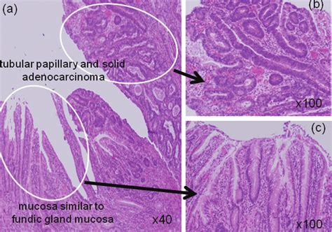 Pathological Findings Tubular Papillary And Solid Adenocarcinoma Were