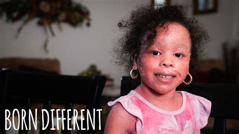The Little Girl Whose Skin Grows Too Fast Born Different Gentnews