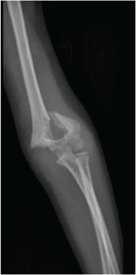 Supracondylar Fracture Of Humerus With Posterior Displacement On First