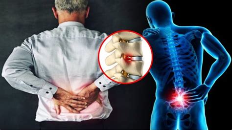 1 year severe slipped disc fixed with chiropractic. Ramai Orang Muda Kena "Slip Disc". Doktor Ini Jelaskan ...
