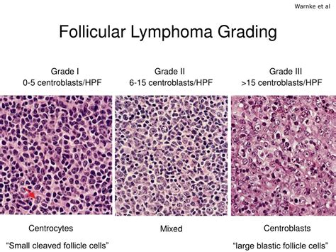 PPT - Follicular Lymphoma PowerPoint Presentation, free ...