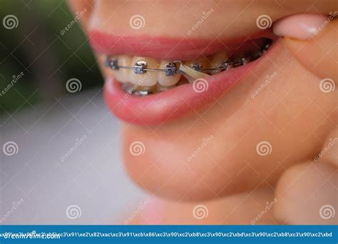 Schöne Junge Frau Mit Klammern Auf Den Zähnen In Der Nähe Stockbild Bild Von Hygiene