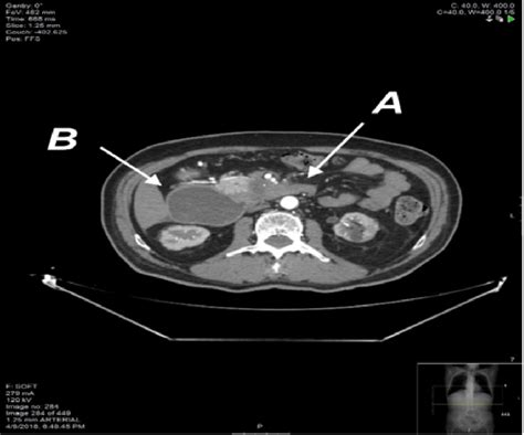 Emergency Pre Operative Ct Abdomen And Pelvis With Oral And Iv Contrast