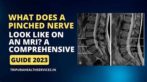 What Does A Pinched Nerve Look Like On An Mri A Comprehensive Guide
