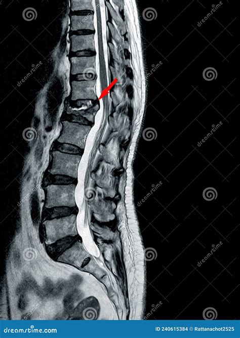 Mri Of Thoracolumbar Spine Moderate To Severe Compression Fracture Of