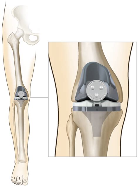 Total Knee Replacement Au