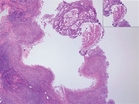 Solitary Nodule On The Thigh Mdedge Dermatology