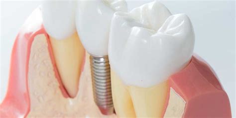 Implantologia A Carico Immediato Dentista Lecco