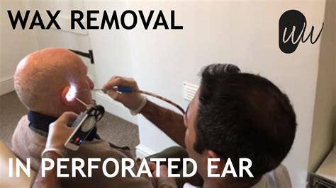 Ear Wax Removal In Ear With Perforated Eardrum 388 Youtube