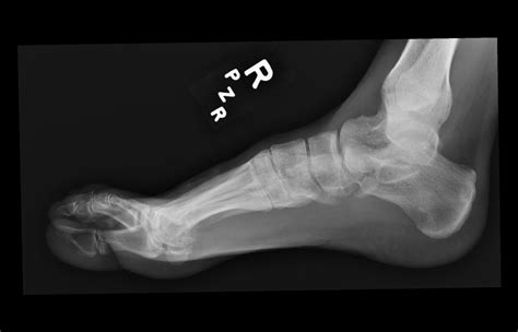 Ortho Dx What Is Causing This Womans Toe Pain Clinical Advisor