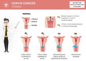 Cervical cancer staging is the assessment of cervical cancer to decide how far the disease has progressed. Cervical Cancer Treatment in Delhi - Dr Sunny Garg BEST ...