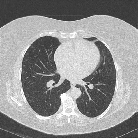Bilateral Diffuse Subcentimetre Pulmonary Nodules Caused By Diffuse