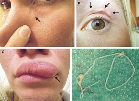 Moving Lump On Woman S Face Turns Out To Be A Worm Newshub