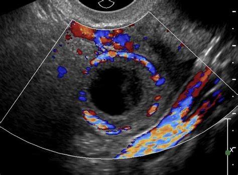 Hemorrhagic Cyst On Ultrasound