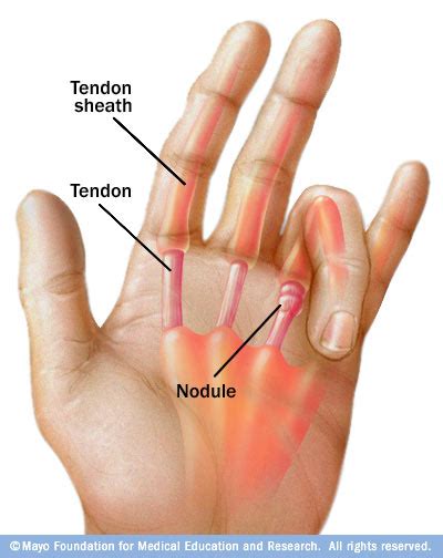 Hand Finger Tendinitis