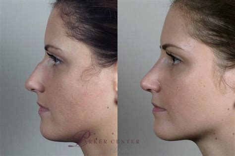 Rhinoplasty Before And After Pictures Case 201 Paramus Nj Parker
