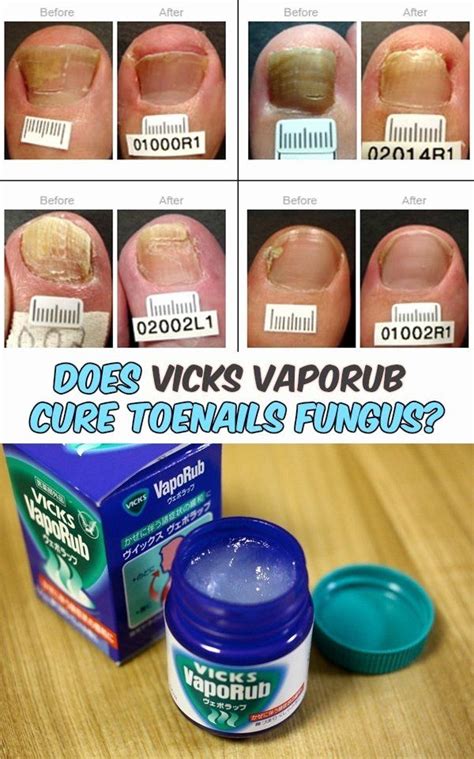 Vicks Nail Fungus Cure Unique Does Vicks Vaporub Cure Toenails Fungus