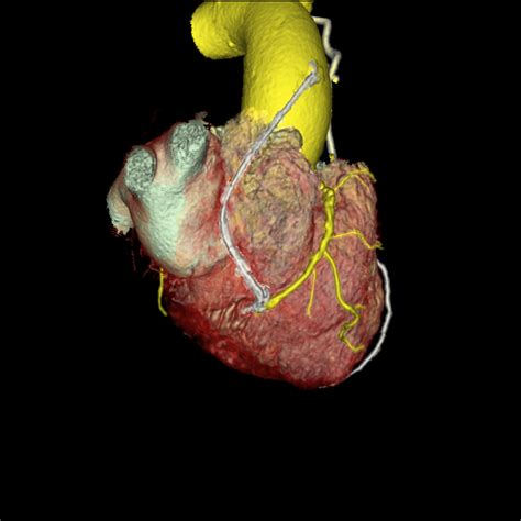 Coronary Artery Bypass Graft Physiopedia
