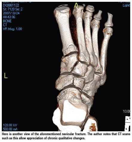 Key Insights For Treating Navicular Stress Fractures