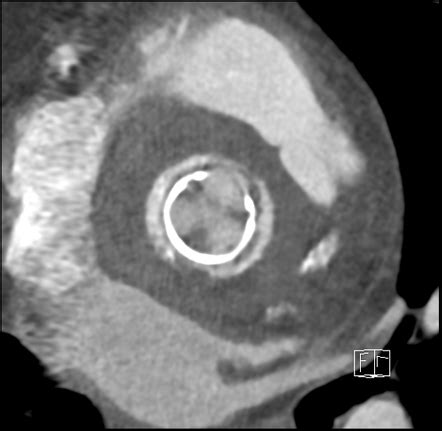 Aortic Root Abscess Radiology Reference Article Radiopaedia Org