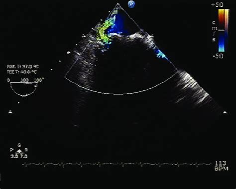 Transoesophageal Echocardiogram Shows The Starredwards Mitral Valve
