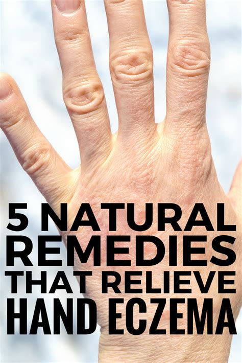 5 Natural Hand Eczema Remedies That Work There Are Different Types Of