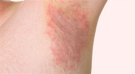 Itching In Armpits Know These 6 Causes Of Armpit Rashes And Tips To