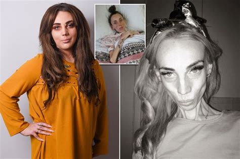 Anorexia Survivor Who Couldnt Feel Her Heart Rate Nearly Died