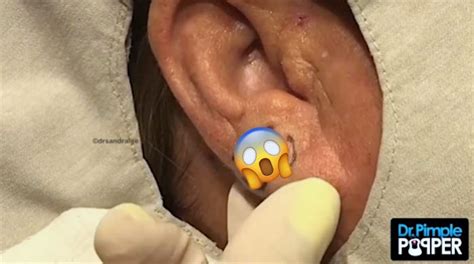 Dr Pimple Popper Squeezes Out An Earlobe Cyst