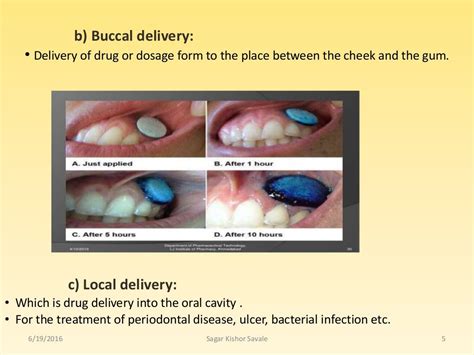 Buccal And Sublingual Drug Delivery System