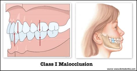 malocclusion of teeth what is it k smile dental care