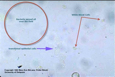 Transitional Epithelial Cells In Urine