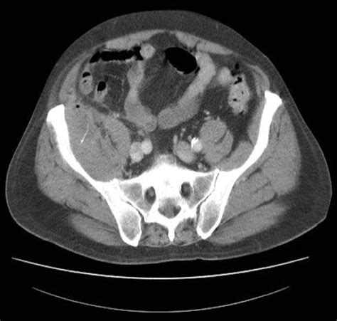 Ct Scan Of The Abdomen Showing An Appendix Mass With A Small Abscess
