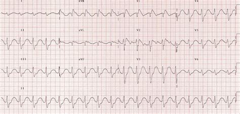 Killer ECG Patterns • LITFL Medical blog • ECG Library