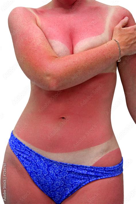 Woman With Bad Sunburn Isolated Stock Photo Adobe Stock