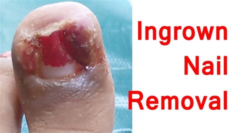 Ingrown Toe Nail Removal Partial Nail Removal Surgery Before After