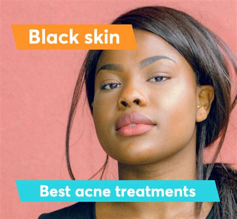 Best Acne Treatment For Black Skin Mdacne