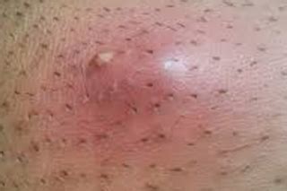 It feels detached from the skin though. Ingrown Pubic Hair | Med Health Daily