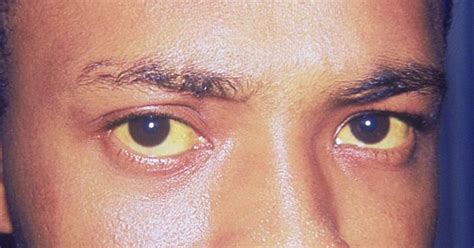 Vitamin B12 Deficiency Symptoms Three Tell Tale Signs In Eyes