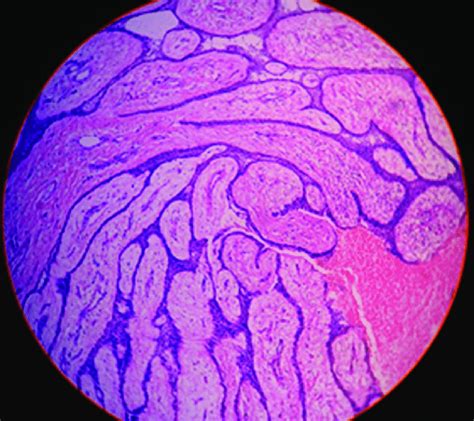 Calcifying Pilomatrixoma Figure 3 Nodular Hidradenoma Download