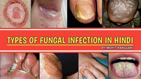 Types Of Fungal Infection On Skin Fungal Infection In Hindi Youtube