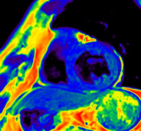 Cardiac Imaging With Compressed Sense Philips Mr Body Map