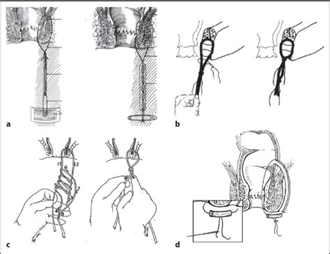 Pdf Setons In The Treatment Of Anal Fistula Review Of Variations In Materials And Techniques