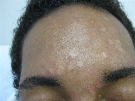 Identifying 21 Common Red Spots On Skin Universal Dermatology