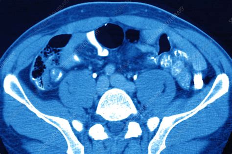 Abdomen Ct Scan Stock Image C0297531 Science Photo Library