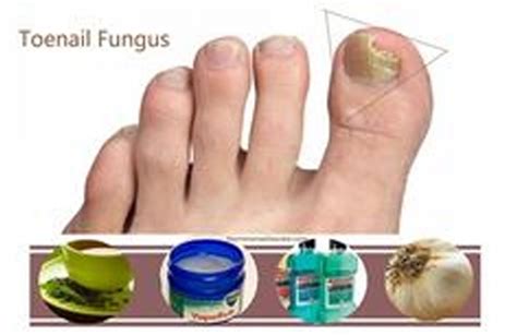 Listerine For Fungus Removal Listerine Foot Soak